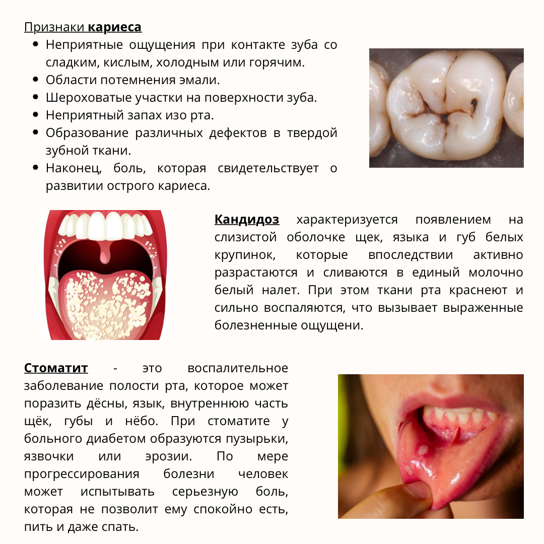 Заболевания полости рта при сахарном диабете